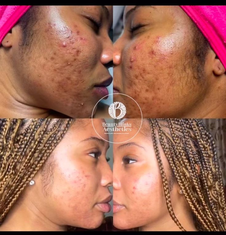 Crème 345 _anti tâche _anti imperfections